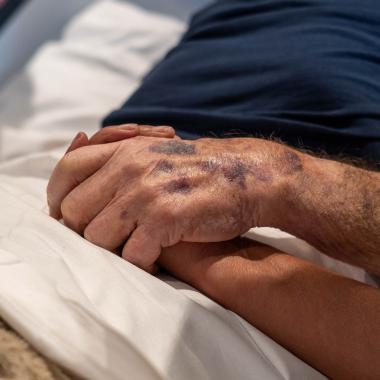 Hands clasped, one with bruises, on white hospital bedding.